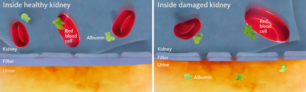 [.CO.UK-en United Kingdom (english)] •	Schematic and simplified view of a healthy and a damaged kidney membrane with the latter illustrating the cause of albuminuria.