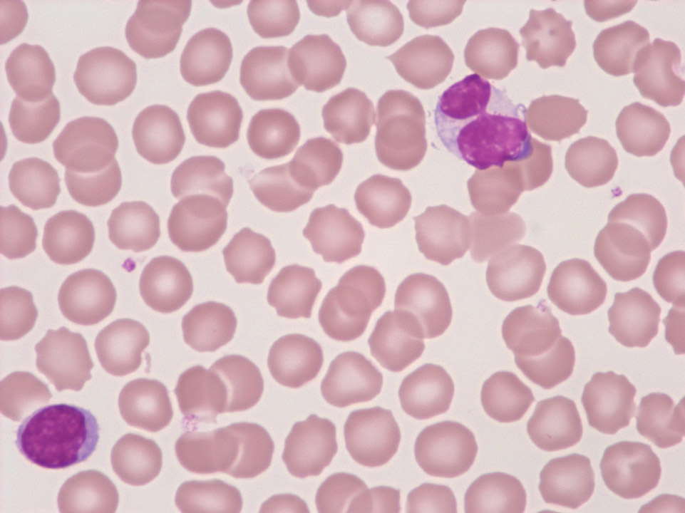 Atypical lymphocyte Atypical lymphocyte