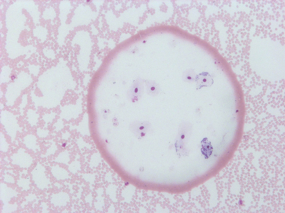 Blood film contaminated by saliva Blood film contaminated by saliva