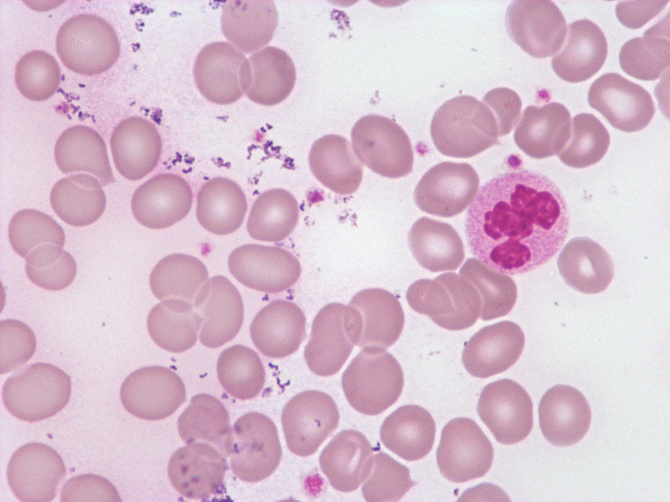 Bacterial aggregates on blood film