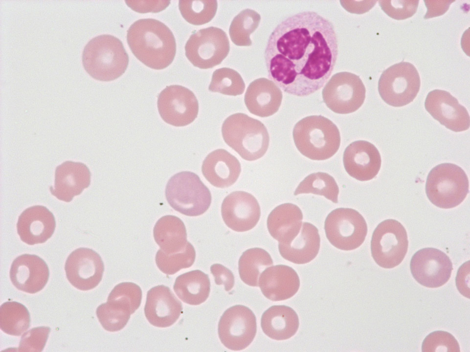Fragmented red blood cells and thrombocytopenia Fragmented red blood cells and thrombocytopenia