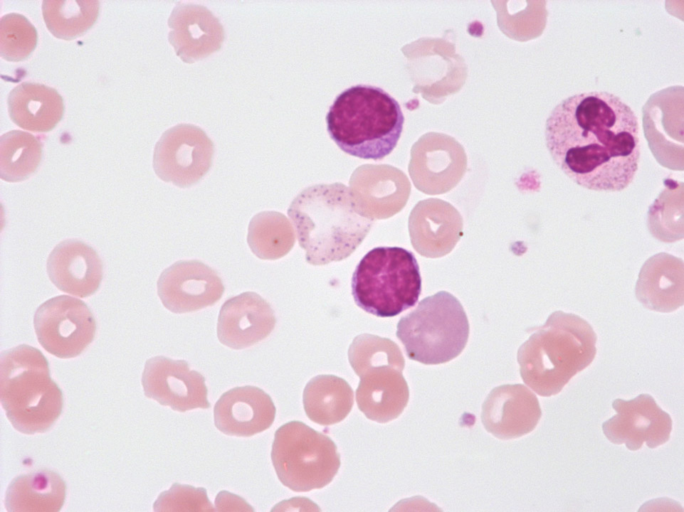 Red blood cell with basophilic stippling and polychromatic red blood cell Red blood cell with basophilic stippling and polychromatic red blood cell