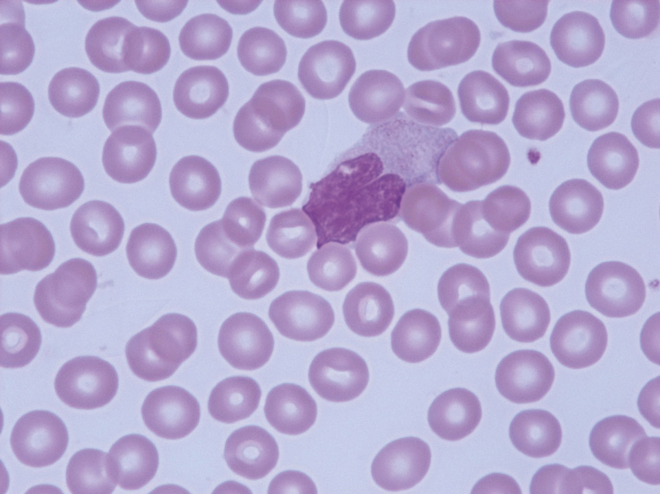 Blood film with staining artefact Blood film with staining artefact