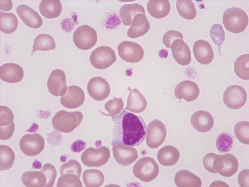Thrombocytosis, anisocytosis of platelets and giant platelets Thrombocytosis, anisocytosis of platelets and giant platelets