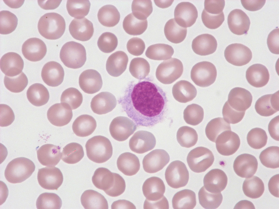 Hairy cell leukaemia Hairy cell leukaemia