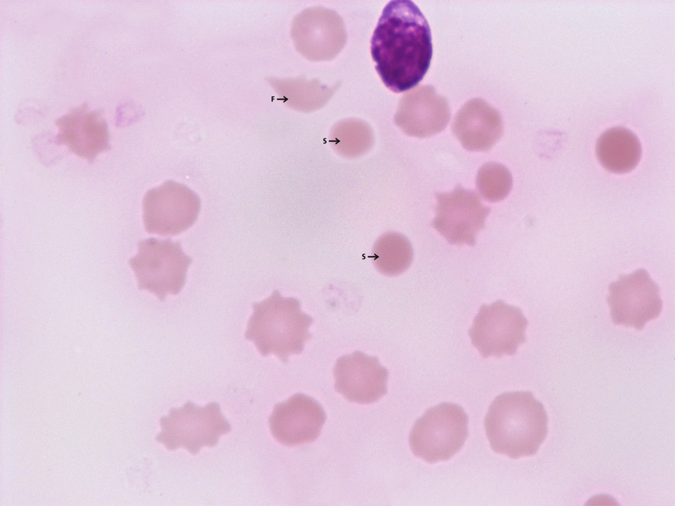 Acute haemolysis Acute haemolysis