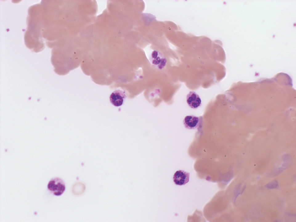 Agglutinated red blood cells and marked polychromasia Agglutinated red blood cells and marked polychromasia