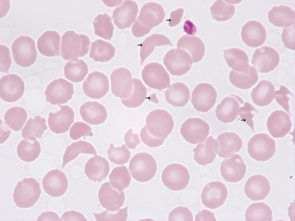 Schistocytes and thrombocytopenia Schistocytes and thrombocytopenia