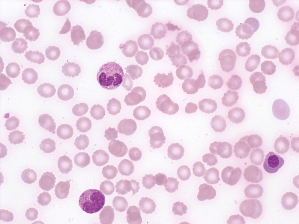 Leucoerythroblastic condition and schistocytes Leucoerythroblastic condition and schistocytes