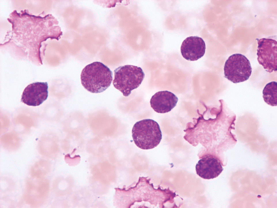 Acute T lymphoblastic leukaemia (T-ALL) Acute T lymphoblastic leukaemia (T-ALL)