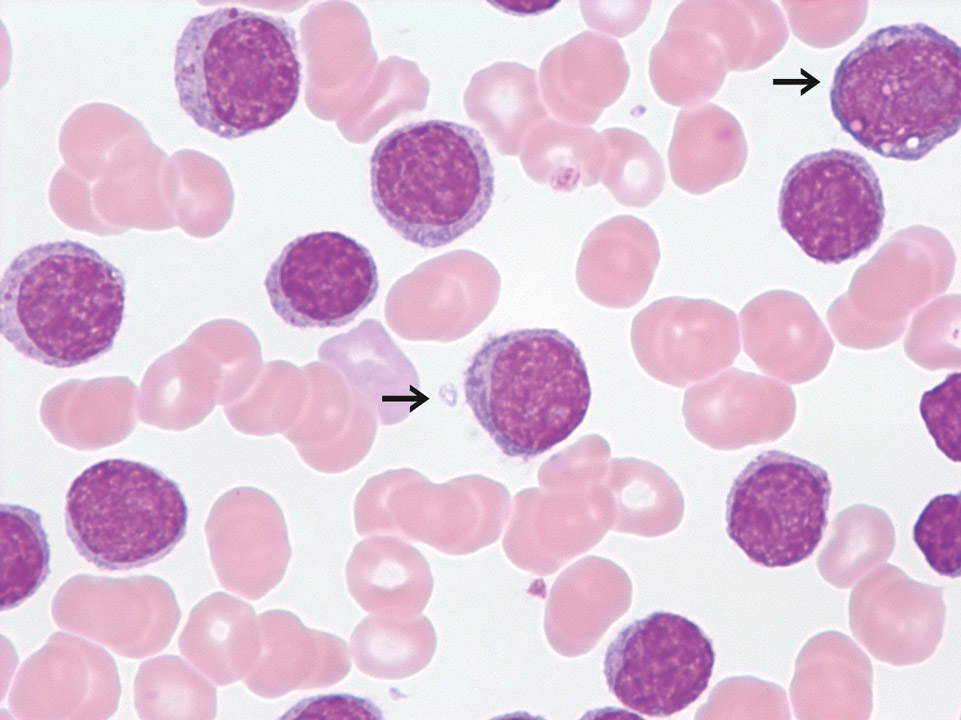 Chronic lymphocytic leukaemia / prolymphocytic leukaemia Chronic lymphocytic leukaemia / prolymphocytic leukaemia