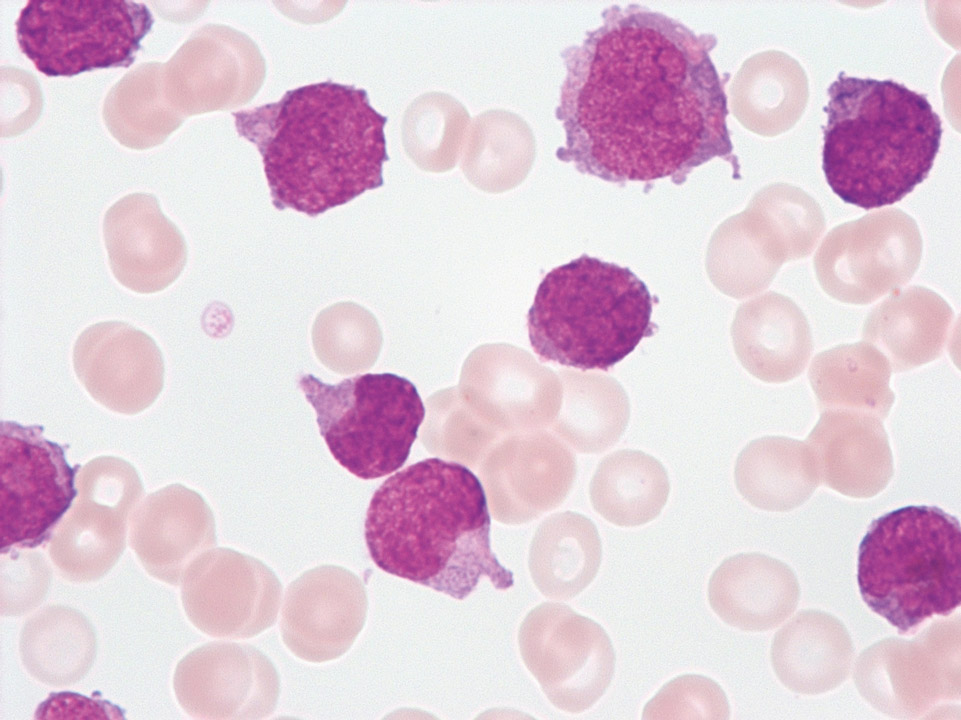 Acute myeloid leukaemia (AML-M4)