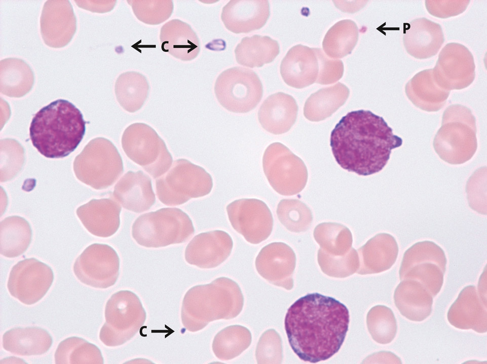 Thrombocytopenia and detection of cytoplasm fragments from monoblasts Thrombocytopenia and detection of cytoplasm fragments from monoblasts