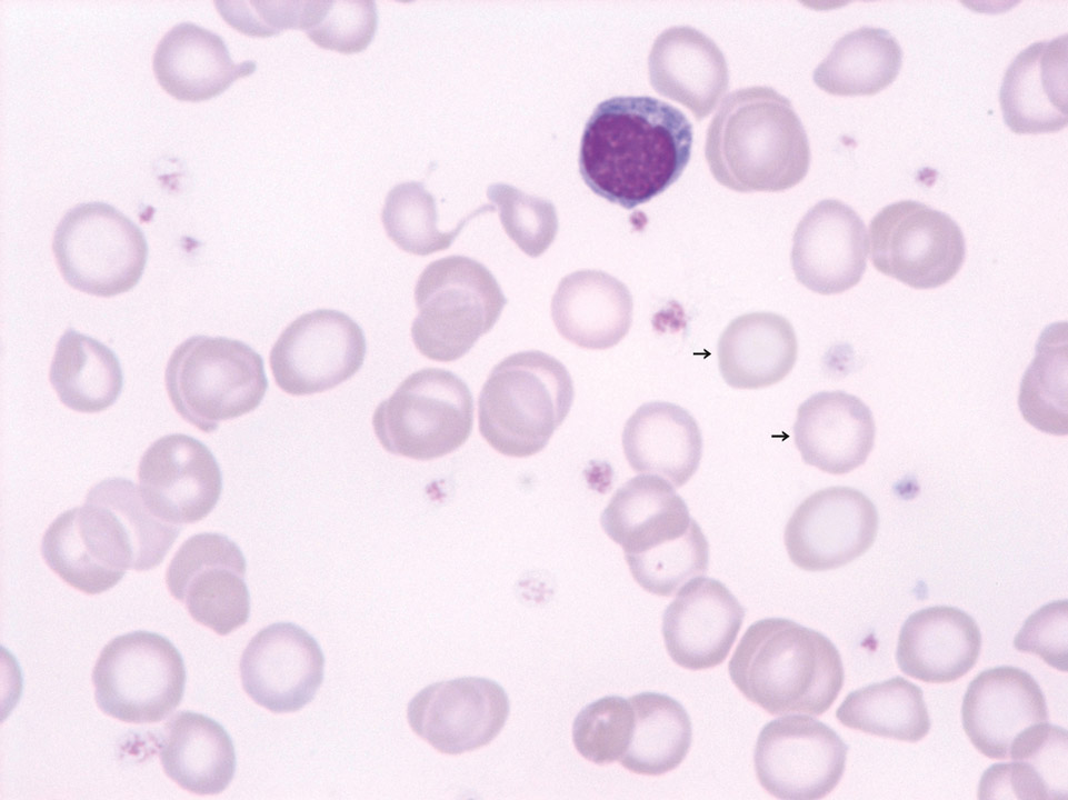 Iron deficiency anaemia Iron deficiency anaemia