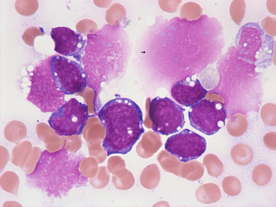 B-ALL / Burkitt lymphoma B-ALL / Burkitt lymphoma