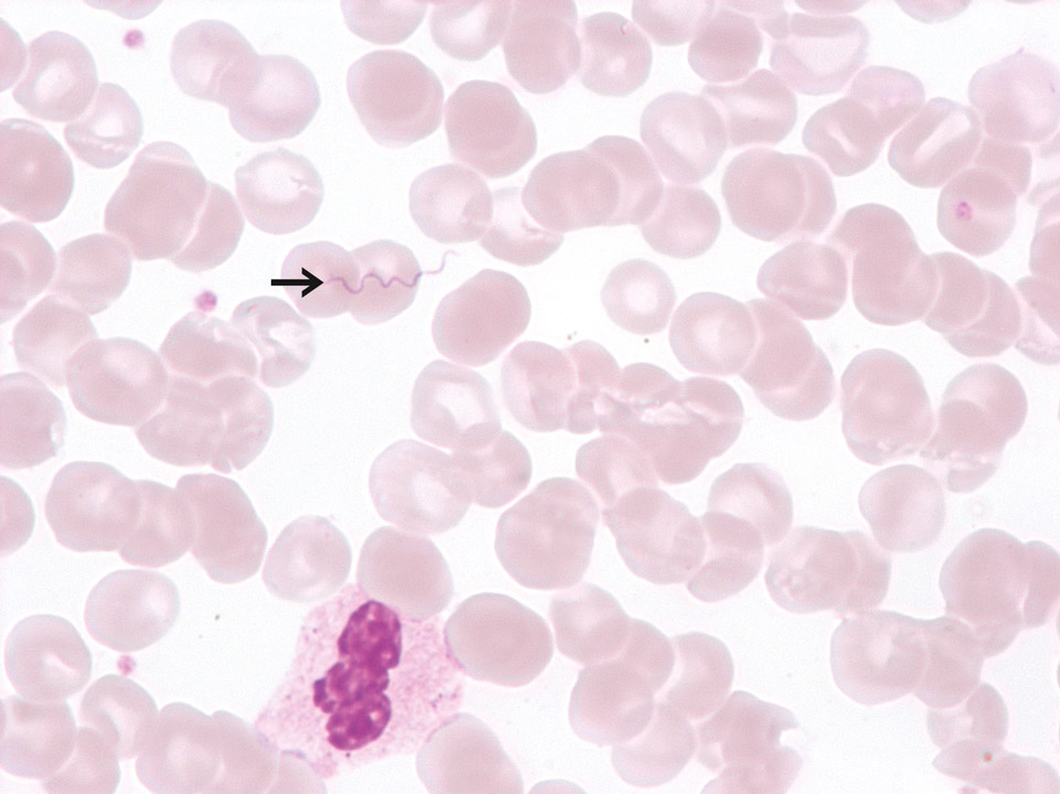 Incidental detection of Borrelia recurrentis Incidental detection of Borrelia recurrentis