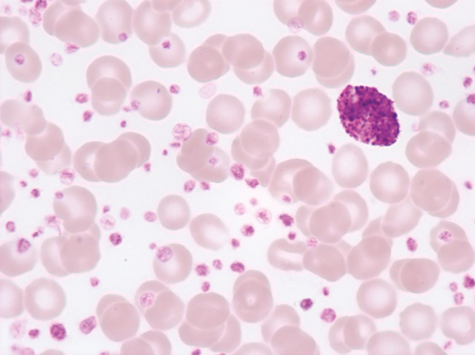 Extreme thrombocytosis in chronic myelogenous leukaemia Extreme thrombocytosis in chronic myelogenous leukaemia