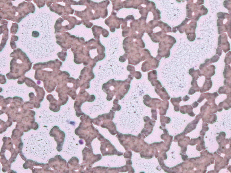 Flocculated cryoglobulin in phase contrast microscopy image Flocculated cryoglobulin in phase contrast microscopy image