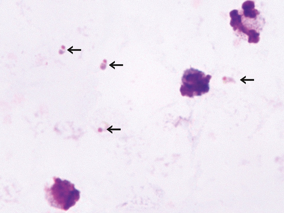 Thick blood film with high density of malaria pathogens Thick blood film with high density of malaria pathogens