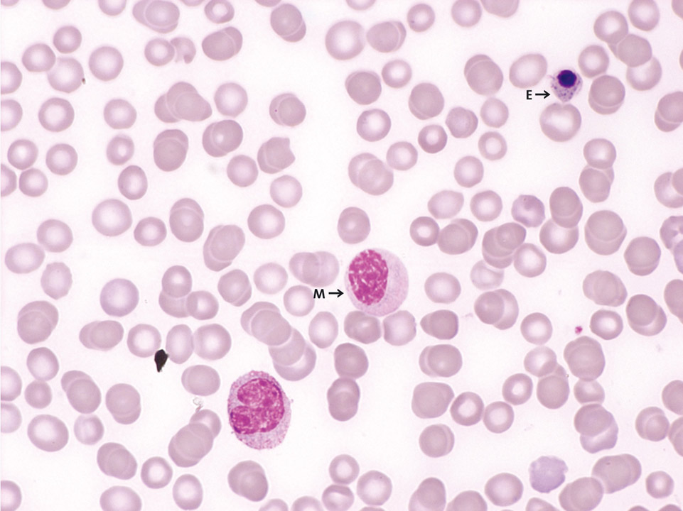 Peripheral blood of a patient with breast cancer and bone metastases Peripheral blood of a patient with breast cancer and bone metastases