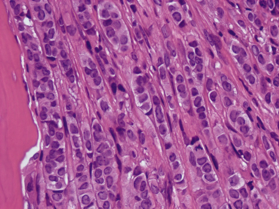 Infiltration of bone marrow by a lobular carcinoma of the breast Infiltration of bone marrow by a lobular carcinoma of the breast
