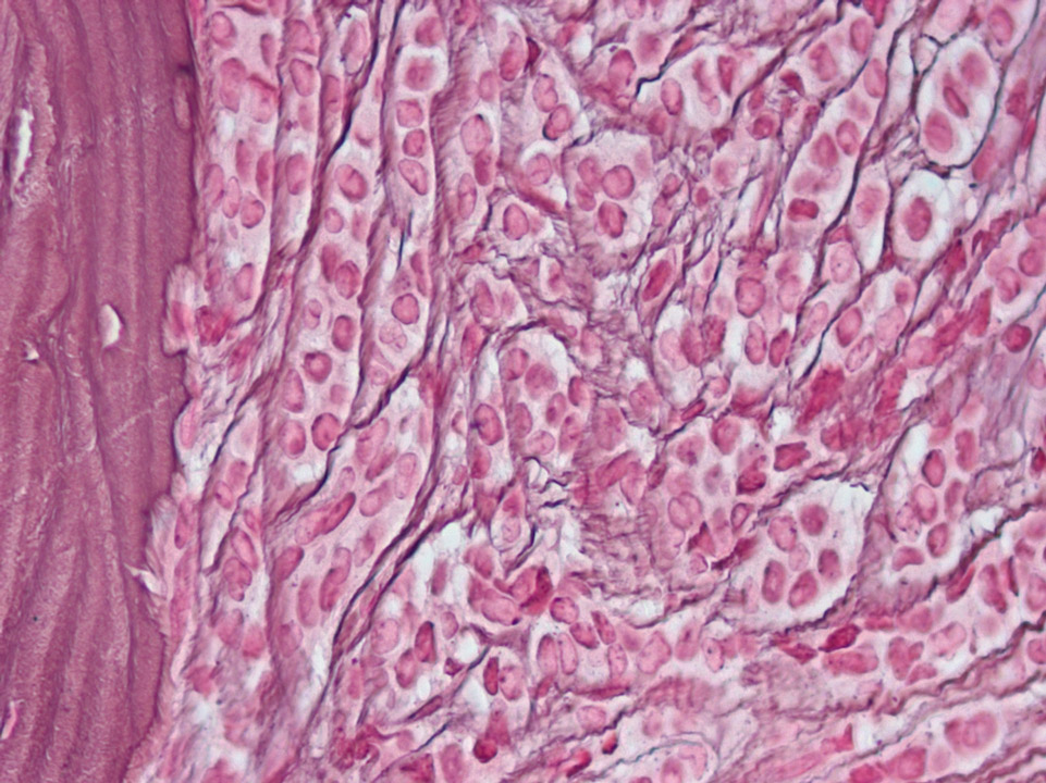 Infiltration of bone marrow by a lobular carcinoma of the breast Infiltration of bone marrow by a lobular carcinoma of the breast