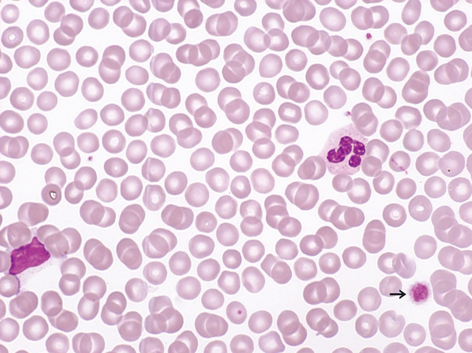 Peripheral blood of a patient with B-CLL Peripheral blood of a patient with B-CLL