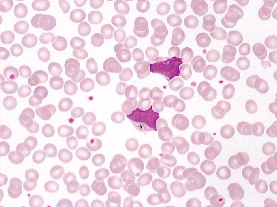 Acute myeloid leukaemia (AML) Acute myeloid leukaemia (AML)