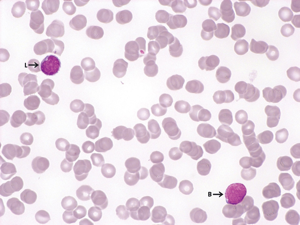 Blast cells in peripheral blood Blast cells in peripheral blood