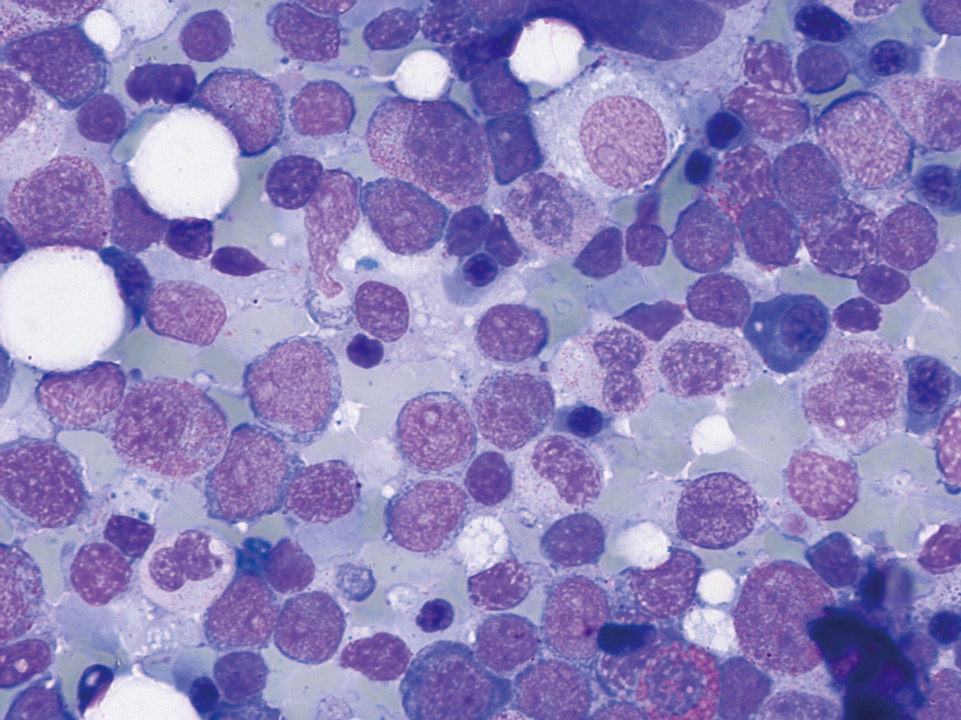 Blasts in bone marrow cytology Blasts in bone marrow cytology