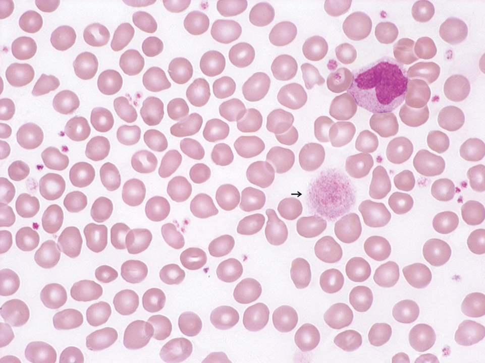 Giant platelets in peripheral blood Giant platelets in peripheral blood