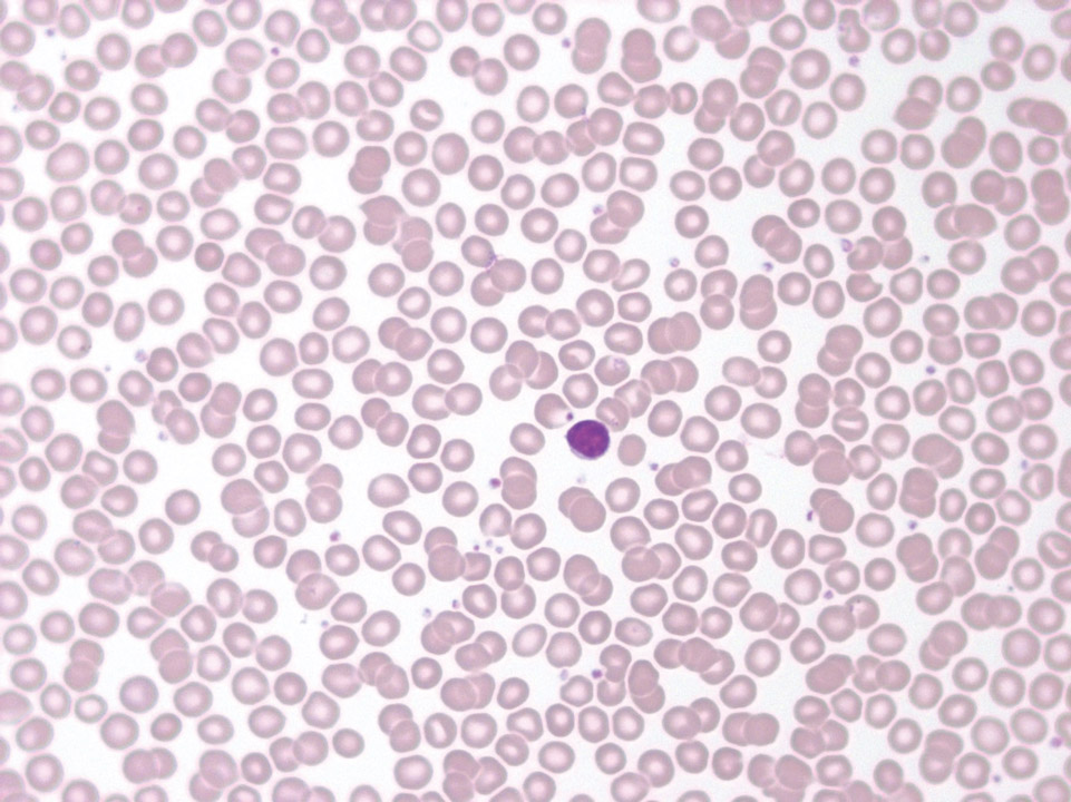 Peripheral blood of a patient showing isolated neutropenia Peripheral blood of a patient showing isolated neutropenia