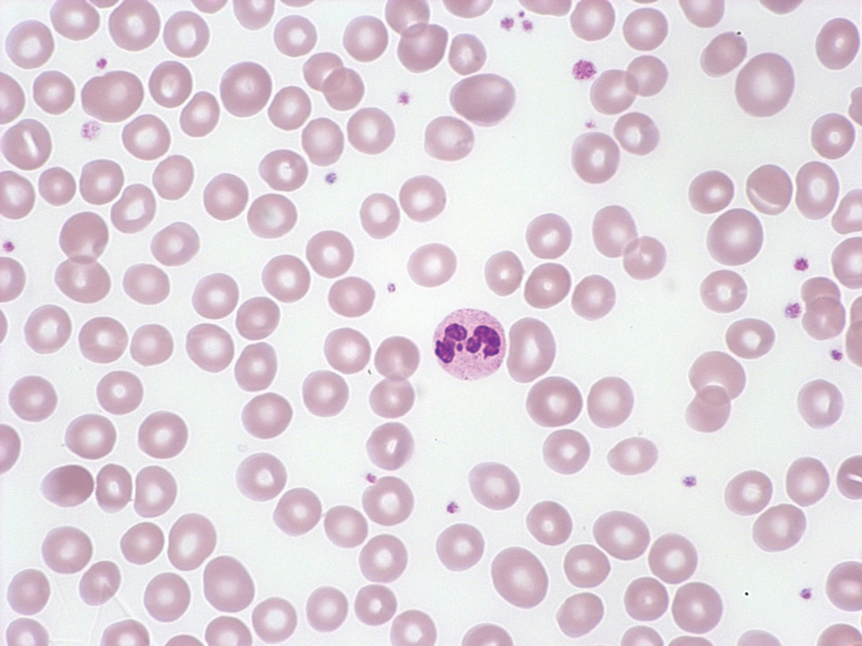 Isolated congenital reduction of erythropoiesis in bone marrow Isolated congenital reduction of erythropoiesis in bone marrow
