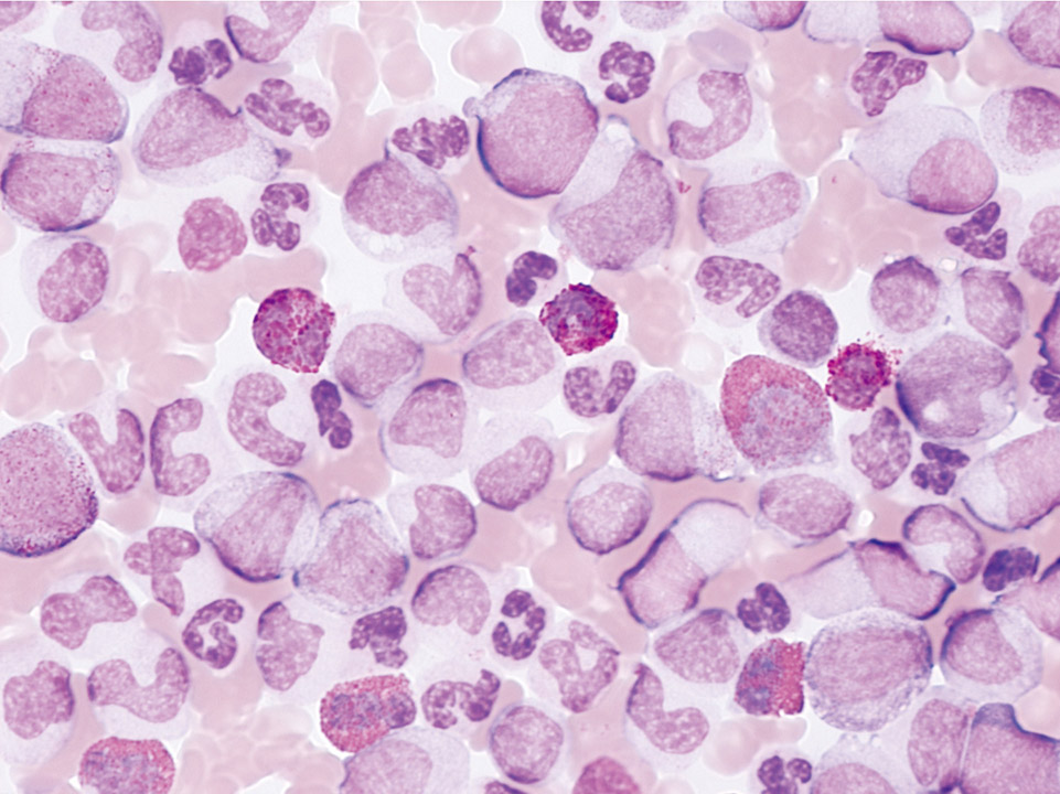Peripheral blood of a patient with CML Peripheral blood of a patient with CML