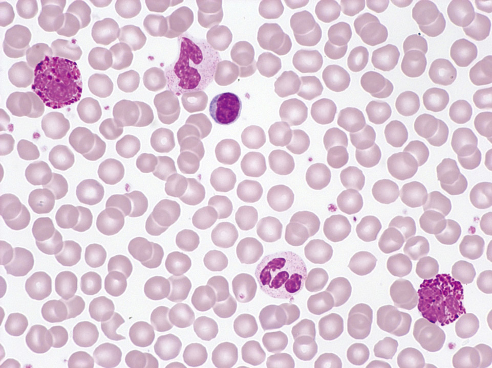 Peripheral blood of a patient with CML Peripheral blood of a patient with CML