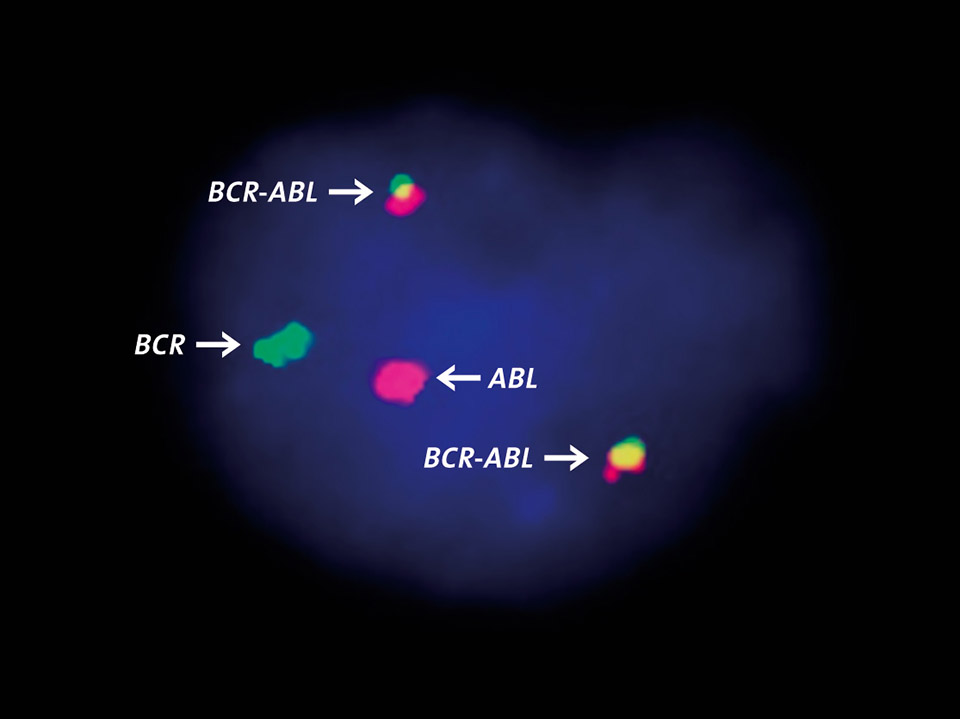 BCR-ABL fusion gene detected by fluorescence-in-situ-hybridisation BCR-ABL fusion gene detected by fluorescence-in-situ-hybridisation