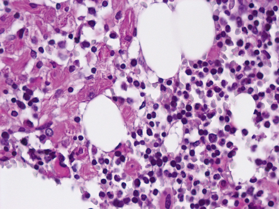Gaucher cells Gaucher cells