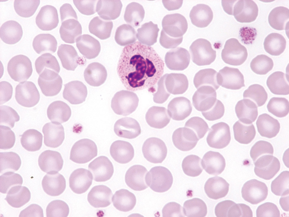 Increase of all three cell lineages in peripheral blood of a patient with PV Increase of all three cell lineages in peripheral blood of a patient with PV