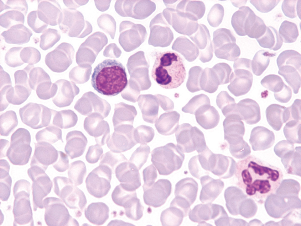 Blood film of a patient with polycythaemia vera (PV) Blood film of a patient with polycythaemia vera (PV)