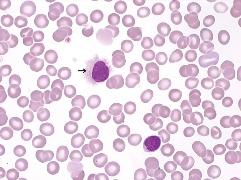 Hairy cell leukaemia Hairy cell leukaemia