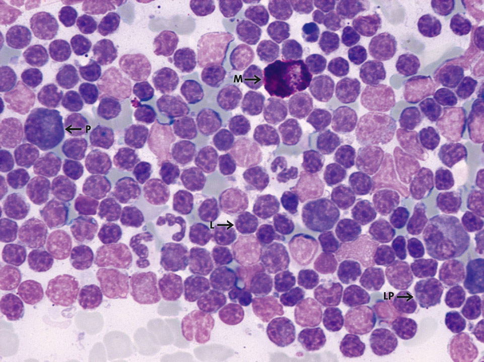 Bone marrow cytology of a patient with immunocytoma