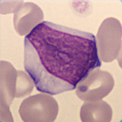 Atypical lymphocytes suspected reactive Atypical lymphocytes suspected reactive