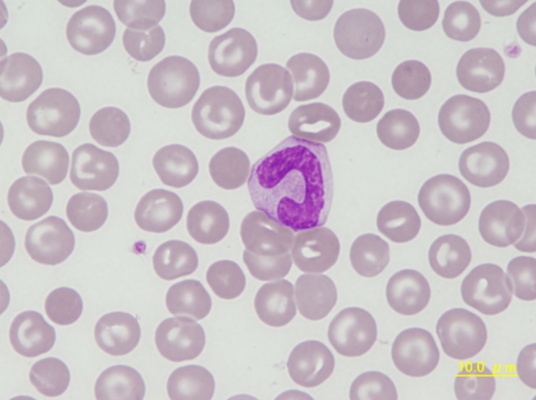 Canine spherocytes and band neutrophil