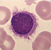 Hairy cell Hairy cell