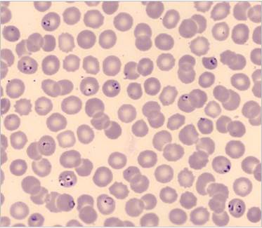 Ring forms of Plasmodium falciparum Ring forms of Plasmodium falciparum