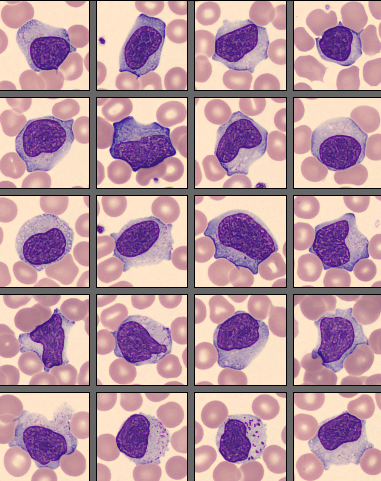 Mononucleosis Mononucleosis