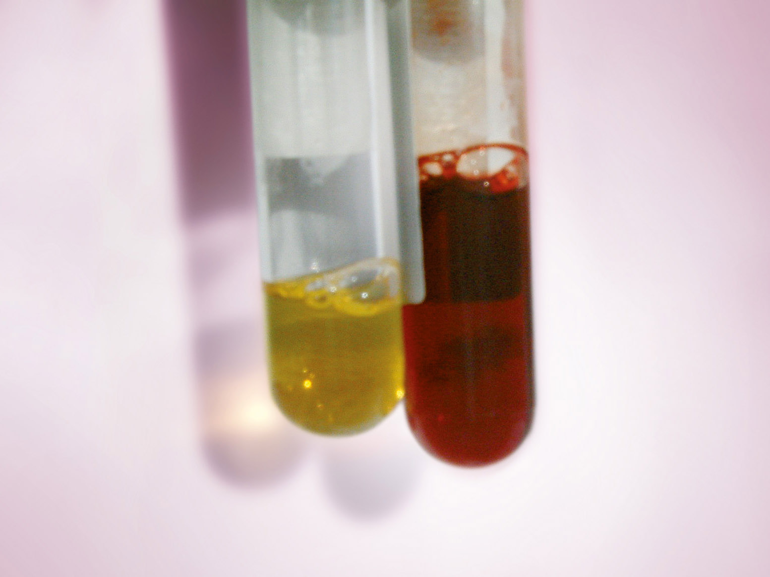 Blood sample reflecting acute intravascular haemolysis Blood sample reflecting acute intravascular haemolysis